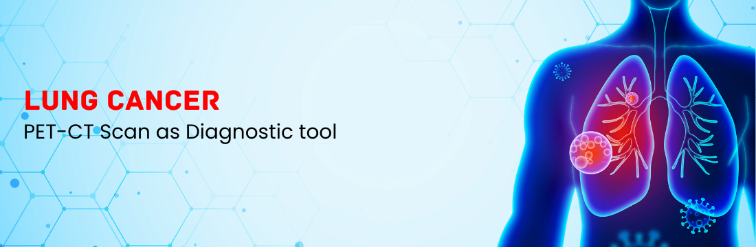 PET-CT Scan as Diagnostic tool for Lung Cancer